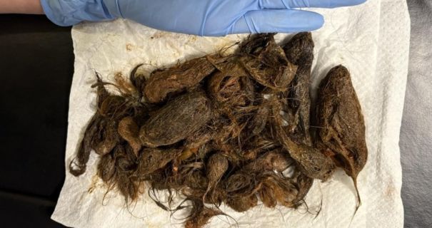 На Волині медики витягли зі шлунка 7-річної дівчинки майже 1 кг волосся На Волині медики витягли зі шлунка 7-річної дівчинки майже 1 кг волосся