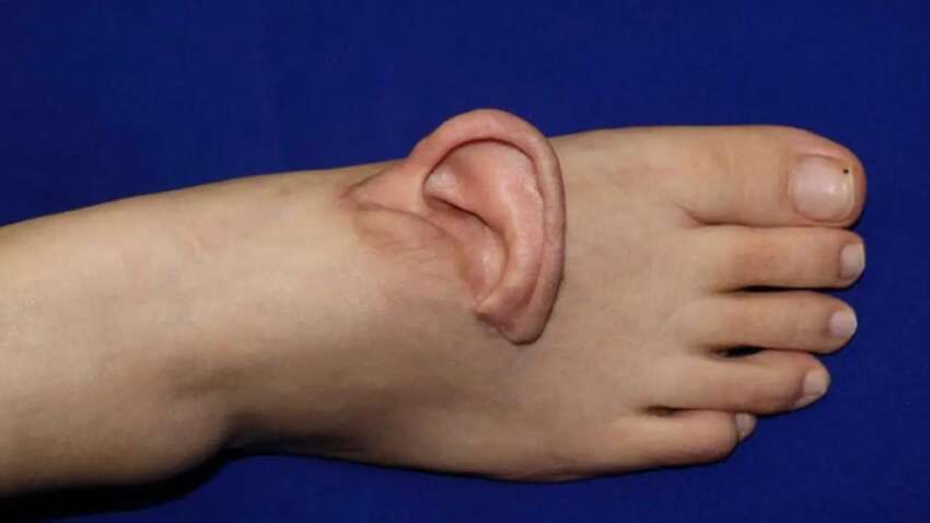 Пришили вухо до ноги: китайські хірурги пішли на шокуючий крок, щоб урятувати пацієнтку Пришили вухо до ноги: китайські хірурги пішли на шокуючий крок, щоб урятувати пацієнтку