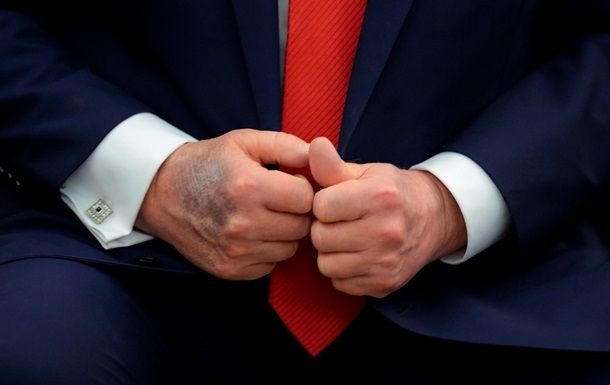 Трамп розповів, звідки у нього синці на руках Трамп розповів, звідки у нього синці на руках