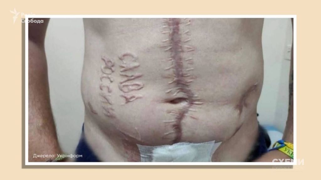 Хто випалив «Слава России» на тілі українського полоненого: журналісти встановили імена російських хірургів (фото) Хто випалив «Слава России» на тілі українського полоненого: журналісти встановили імена російських хірургів (фото)