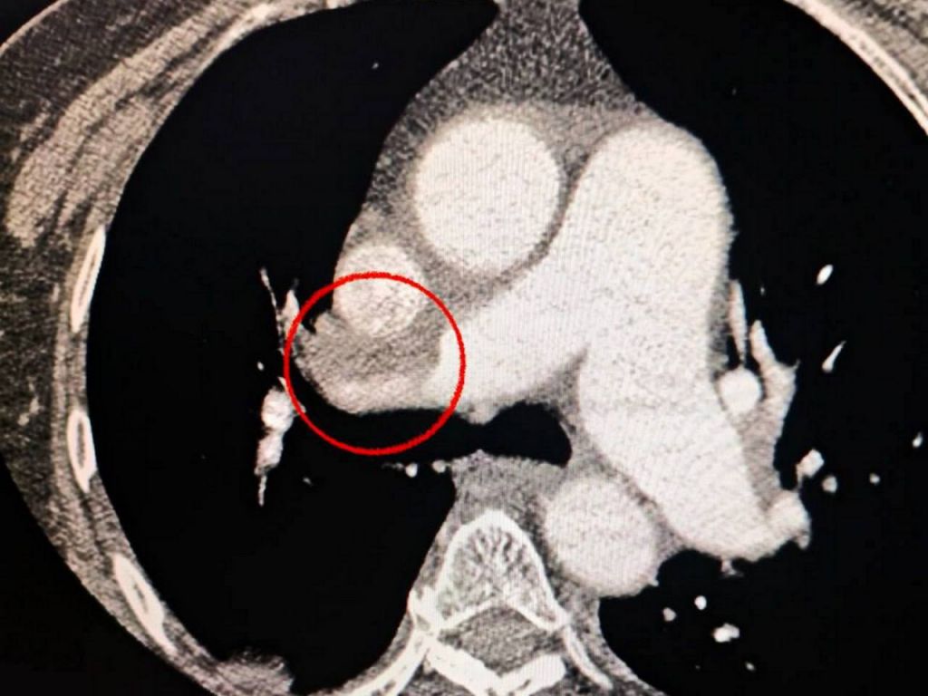 Врятоване життя: одеські медики провели унікальну подвійну операцію Врятоване життя: одеські медики провели унікальну подвійну операцію