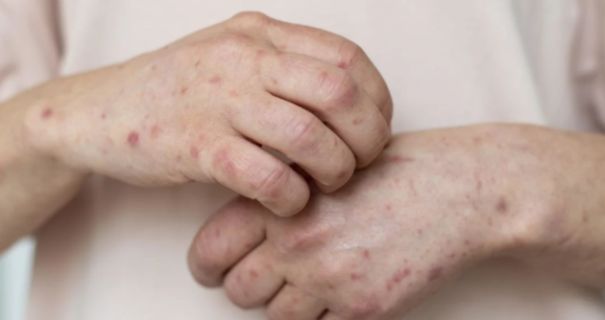 Спалах кору на Прикарпатті: що заборонять і кого це стосується Спалах кору на Прикарпатті: що заборонять і кого це стосується